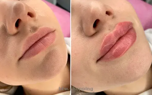 Контурування губ у Києві (Солом'янка) - зволоження і збільшення губ